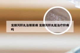龙胆泻肝丸治银屑病 龙胆泻肝丸能治疗肝病吗