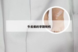 牛皮癣的早期样吗