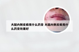 大腿内侧皮癣用什么药膏 大腿内侧皮癣用什么药膏效果好