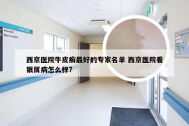 西京医院牛皮癣最好的专家名单 西京医院看银屑病怎么样?