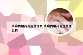 头癣内服药首选是什么 头癣内服药首选是什么药