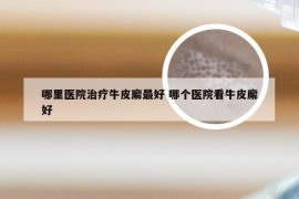 哪里医院治疗牛皮廨最好 哪个医院看牛皮廨好