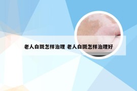 老人白斑怎样治理 老人白斑怎样治理好