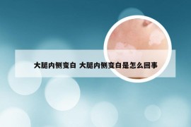 大腿内侧变白 大腿内侧变白是怎么回事