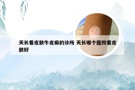 天长看皮肤牛皮癣的诊所 天长哪个医院看皮肤好
