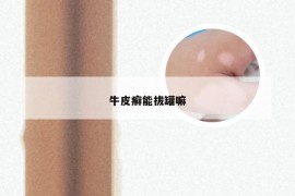 牛皮癣能拔罐嘛