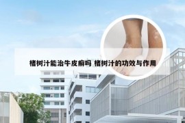 楮树汁能治牛皮癣吗 楮树汁的功效与作用