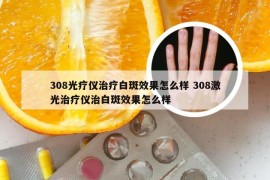 308光疗仪治疗白斑效果怎么样 308激光治疗仪治白斑效果怎么样
