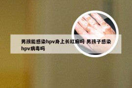 男孩能感染hpv身上长红癣吗 男孩子感染hpv病毒吗