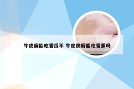 牛皮癣能吃香瓜不 牛皮肤癣能吃香蕉吗