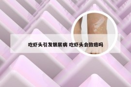 吃虾头引发银屑病 吃虾头会致癌吗