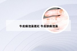 牛皮癣泡澡更红 牛皮肤癣泡澡