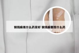 铜钱癣用什么药膏好 铜钱癣要擦什么药