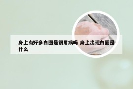 身上有好多白圈是银屑病吗 身上出现白圈是什么