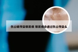 伤口破传染银屑病 银屑病会通过伤口传染么
