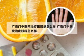 广安门中医院治疗银屑病怎么样 广安门中医院治皮肤科怎么样