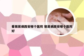 看银屑病西安哪个医院 银屑病西安哪个医院好