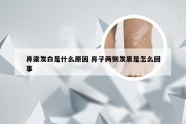 鼻梁发白是什么原因 鼻子两侧发黑是怎么回事