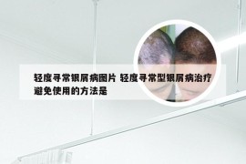 轻度寻常银屑病图片 轻度寻常型银屑病治疗避免使用的方法是