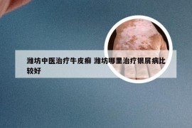 潍坊中医治疗牛皮癣 潍坊哪里治疗银屑病比较好