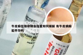 牛皮癣在排卵期会加重如何缓解 有牛皮病癣能怀孕吗