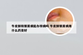 牛皮鲜和银屑病能办特病吗 牛皮鲜银屑病用什么药膏好