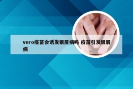 vero疫苗会诱发银屑病吗 疫苗引发银屑病