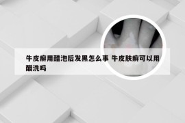 牛皮癣用醋泡后发黑怎么事 牛皮肤癣可以用醋洗吗