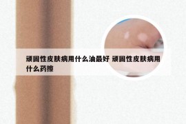 顽固性皮肤病用什么油最好 顽固性皮肤病用什么药擦