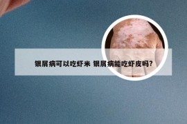 银屑病可以吃虾米 银屑病能吃虾皮吗?