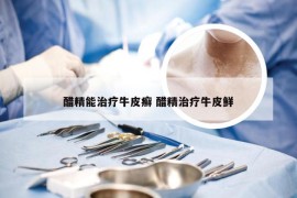 醋精能治疗牛皮癣 醋精治疗牛皮鲜