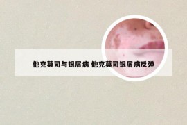 他克莫司与银屑病 他克莫司银屑病反弹