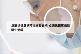 点滴状银屑病可以吃甜食吗 点滴状银屑病能喝牛奶吗
