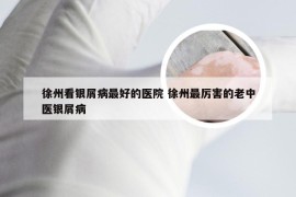 徐州看银屑病最好的医院 徐州最厉害的老中医银屑病