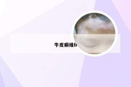 牛皮癣维b