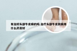 有治好头部牛皮癣的吗 治疗头部牛皮肤癣用什么药膏好