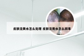 皮肤流黄水怎么处理 皮肤流黄水怎么回事