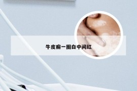 牛皮癣一圈白中间红