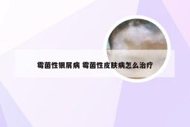 霉菌性银屑病 霉菌性皮肤病怎么治疗