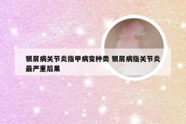 银屑病关节炎指甲病变种类 银屑病指关节炎最严重后果