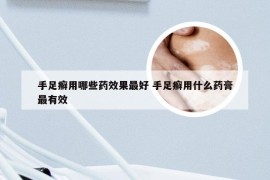 手足癣用哪些药效果最好 手足癣用什么药膏最有效