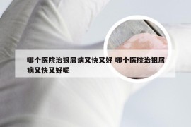 哪个医院治银屑病又快又好 哪个医院治银屑病又快又好呢