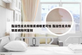 脂溢性皮炎和银屑病哪更可怕 脂溢性皮炎和银屑病如何鉴别