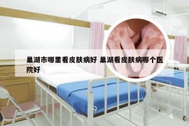 巢湖市哪里看皮肤病好 巢湖看皮肤病哪个医院好