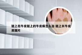 腿上出牛皮腿上的牛皮癣怎么治 腿上长牛皮屑图片