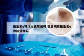 维生素e可以治银屑病吗 银屑病用维生素e涂能退红吗