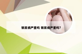 银屑病严重吗 银屑病严重吗?