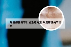 牛皮癣性关节炎的治疗方法 牛皮廨性关节炎的