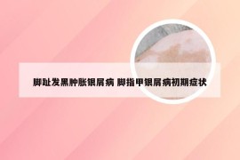 脚趾发黑肿胀银屑病 脚指甲银屑病初期症状