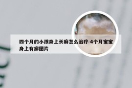 四个月的小孩身上长癣怎么治疗 4个月宝宝身上有癣图片